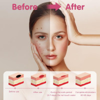 Комплект для удаления родинок AOGOE 1103, с 9 режимами и ЖК-дисплеем (0149)